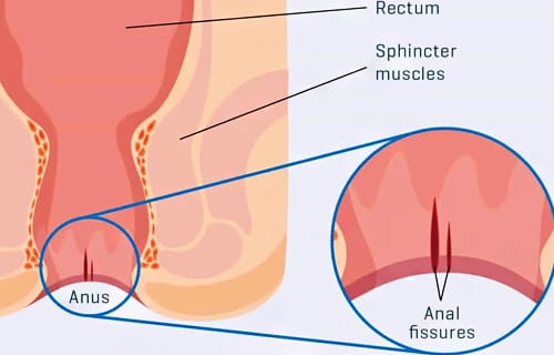 Fissure in Ano Medical Illustration