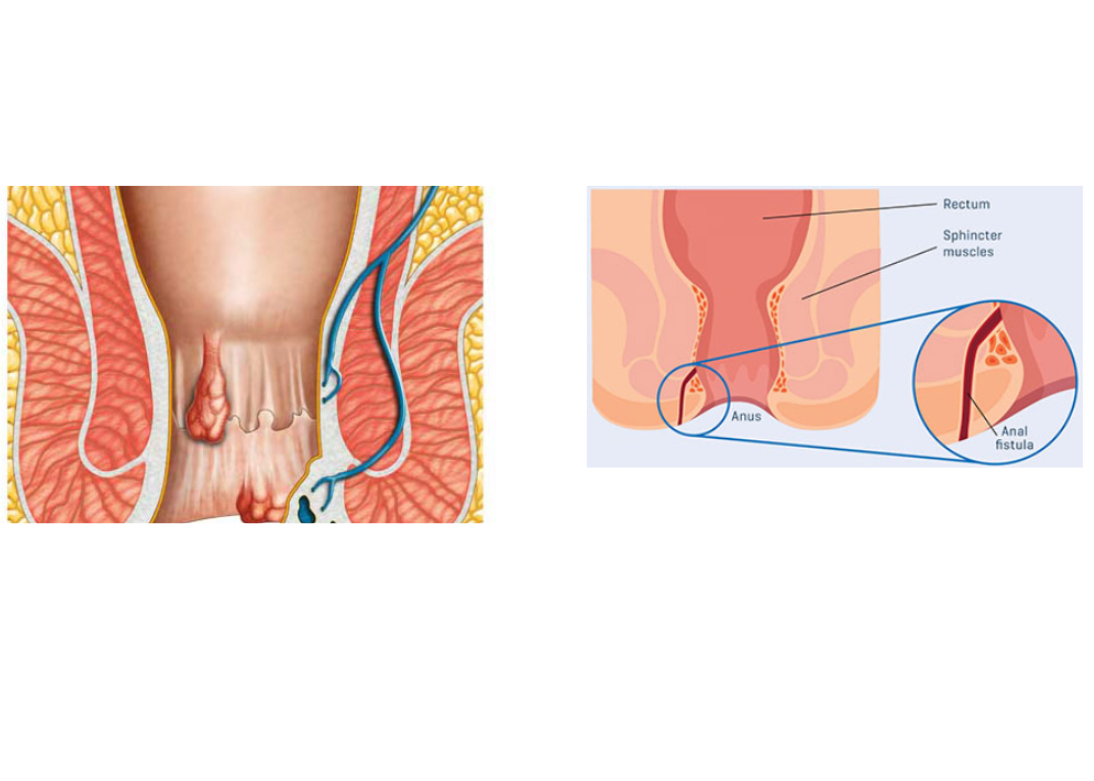 Fistula in Ano Medical Illustration